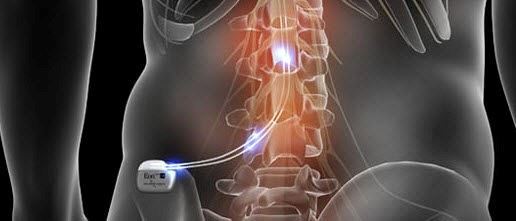 abbott spinal cord stimulator electronic